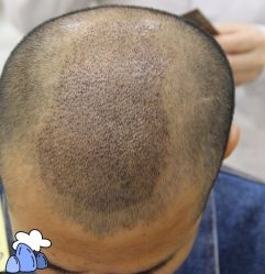 -大麦微针植发丨全国连锁