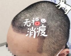 -大麦微针植发全国连锁