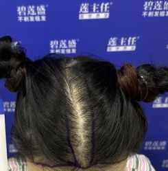 -碧莲盛·不剃发植发