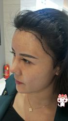 -大麦微针植发丨全国连锁