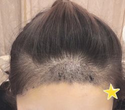 -大麦微针植发丨全国连锁