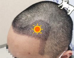 -大麦微针植发全国连锁