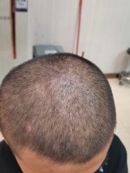 点击看大图 -新生植发·植养护一体