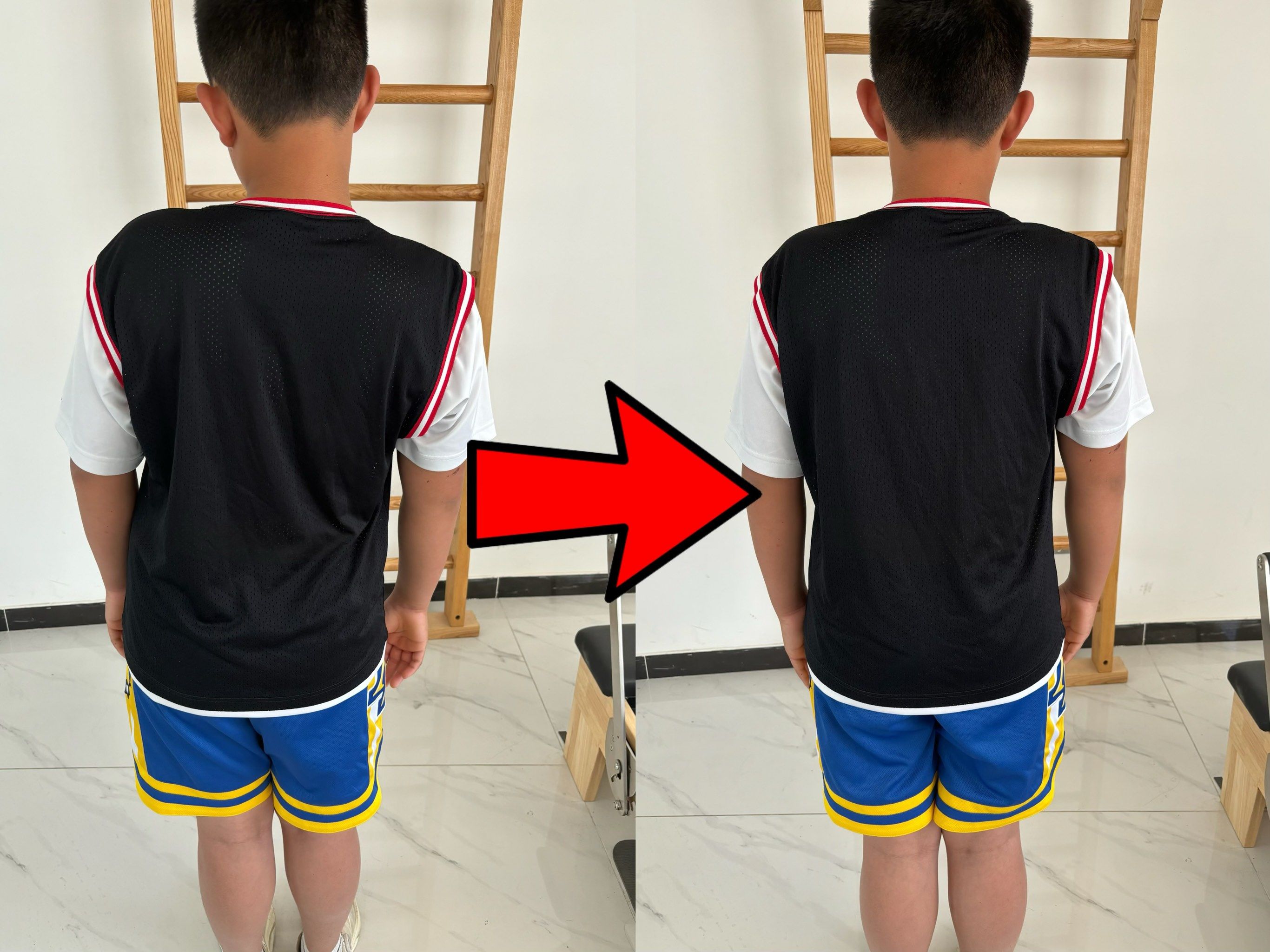 青少年突发性脊柱侧弯康复前后效果对比图