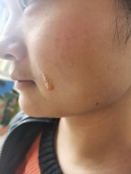 体验后-杭州海亮医院 · 禾芸嘉医美中心