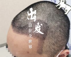 -大麦微针植发全国连锁