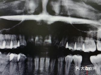 种植牙能用多久？能用一辈子吗？