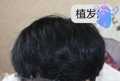 -大麦微针植发全国连锁