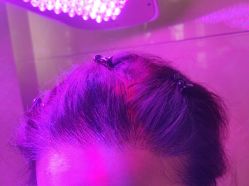 -碧莲盛·不剃发植发