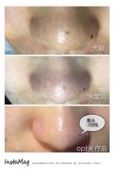 脸部抗衰-光SPA科技美肤