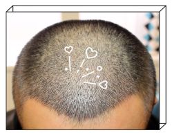 -大麦微针植发全国连锁