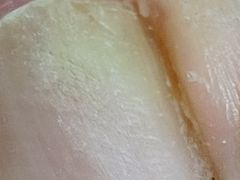 -祖传修脚甲沟炎灰指甲鸡眼