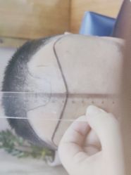 体验前-大麦微针植发全国连锁