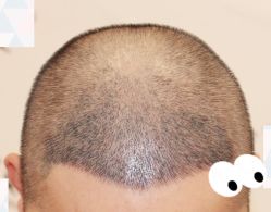 -大麦微针植发全国连锁