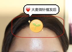 -大麦微针植发全国连锁