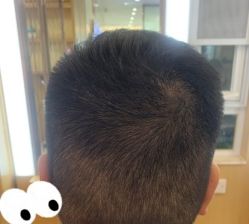 -大麦微针植发丨全国连锁