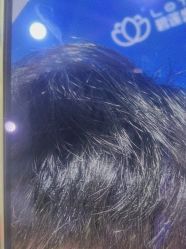 体验后-碧莲盛·不剃发植发