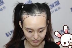 -大麦微针植发丨全国连锁