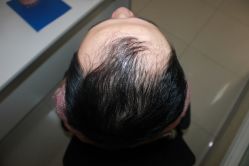 -大麦微针植发丨全国连锁