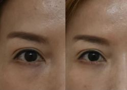 -广州健丽·去眼袋医疗美容机构