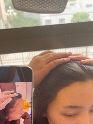 -碧莲盛·不剃发植发