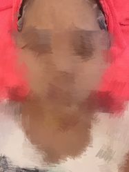 -成都苗方清颜专业祛痘