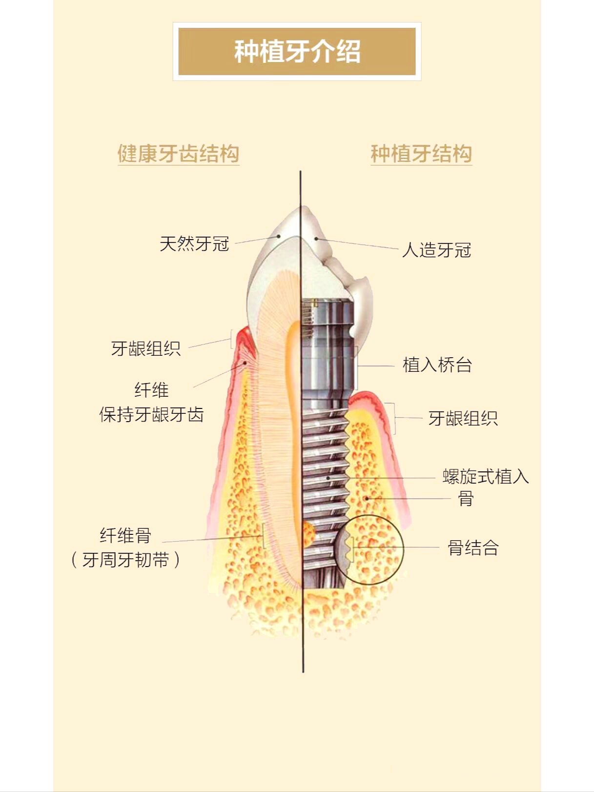 种植牙人工牙根图片图片