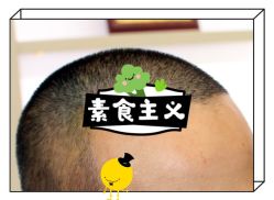 -大麦微针植发全国连锁