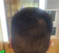 -大麦微针植发丨全国连锁