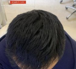 -大麦微针植发丨全国连锁