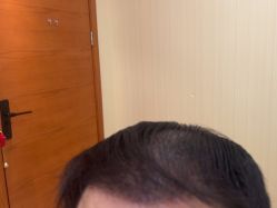 -碧莲盛·不剃发植发