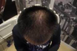 点击看大图 -大麦微针植发丨全国连锁