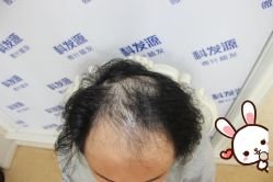 -大麦微针植发丨全国连锁