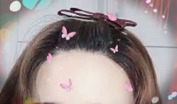 -大麦微针植发全国连锁