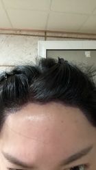 -碧莲盛·不剃发植发