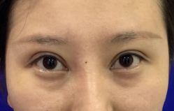 -天津健丽·去眼袋医疗美容机构