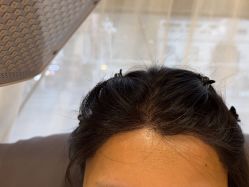 -碧莲盛·不剃发植发