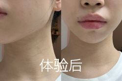 体验后-星和深湾荟医疗美容