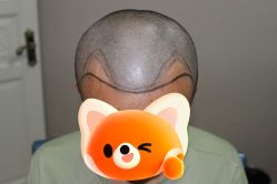 体验前-大麦微针植发全国连锁