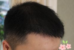 -大麦微针植发丨全国连锁