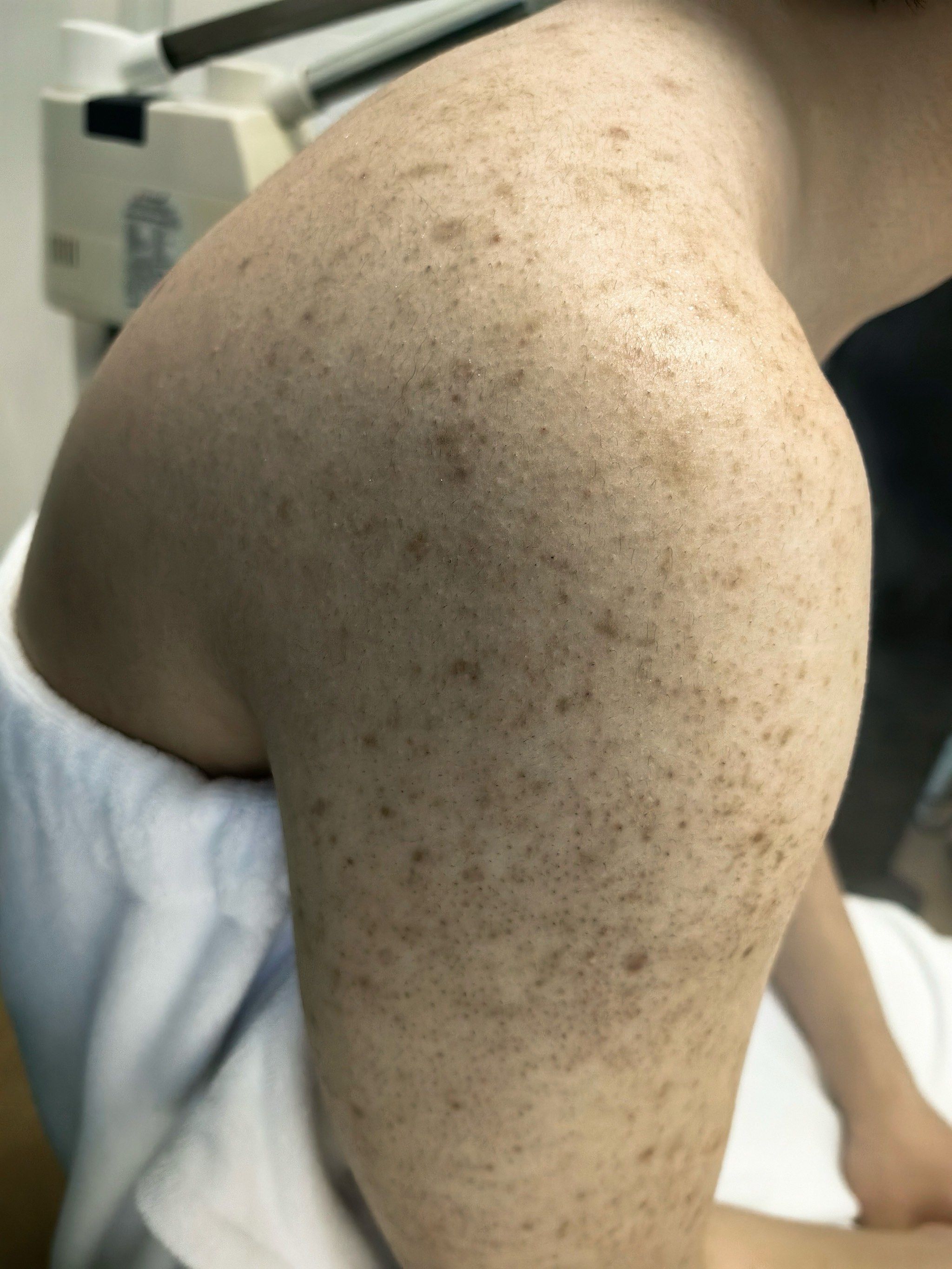 这是我见过最严重的毛囊炎