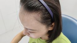 -大麦微针植发全国连锁