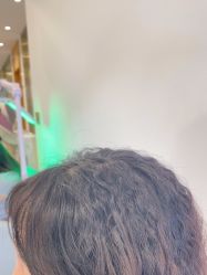 -碧莲盛·不剃发植发
