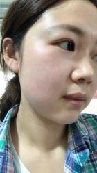 点击看大图 -北京美痣堂古方祛痣斑疣瘊