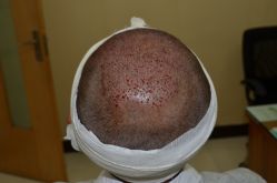 -大麦微针植发丨全国连锁