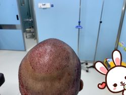 -大麦微针植发丨全国连锁