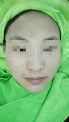 -清颜堂丨分子祛痘·功效美肤