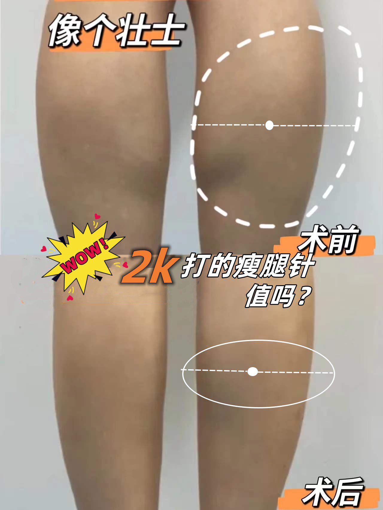 2k打的瘦腿针