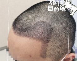 -大麦微针植发全国连锁