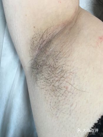 腋下脱毛后真实感受 第二次激光脱腋毛做了有两周了